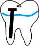 odbudowa zęba na wkładzie standardowym